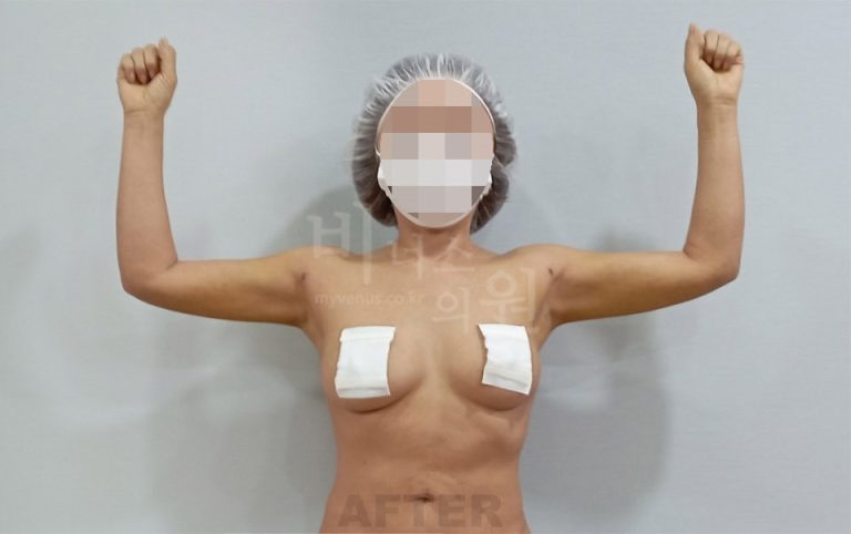 팔뚝지방흡입 수술 후 정면 양팔 위로 든 자세