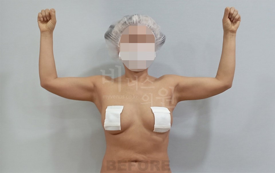 팔뚝지방흡입 수술 전 정면 양팔 위로 든 자세