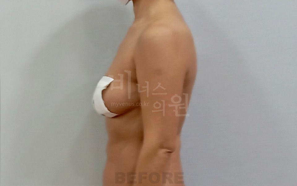 팔뚝지방흡입 수술 전 측면(팔 내린 자세)