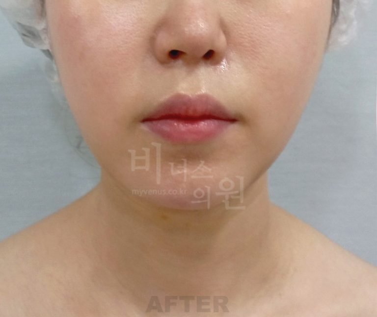 턱 목 부위 수술 후 정면