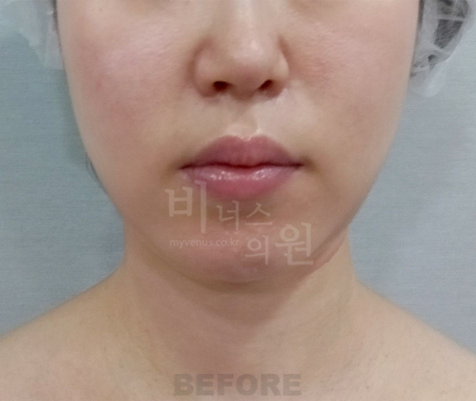 턱 목 부위 수술 전 정면