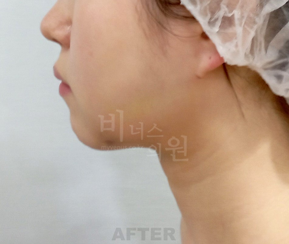 턱 목 부위 수술 후 측면(얼굴이 화면 왼쪽을 향함)