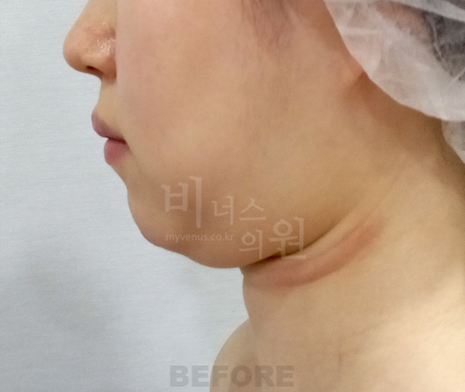 턱 목 부위 수술 전 측면(얼굴이 화면 왼쪽을 향함)