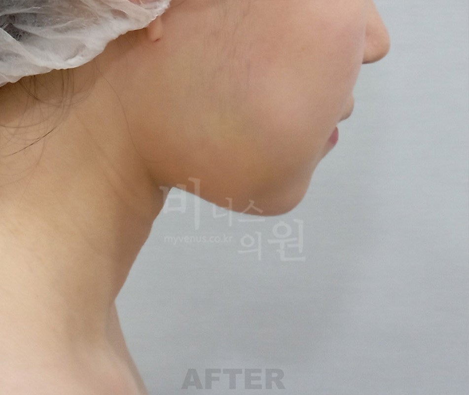 턱 목 부위 수술 후 측면(얼굴이 화면 오른쪽을 향함)