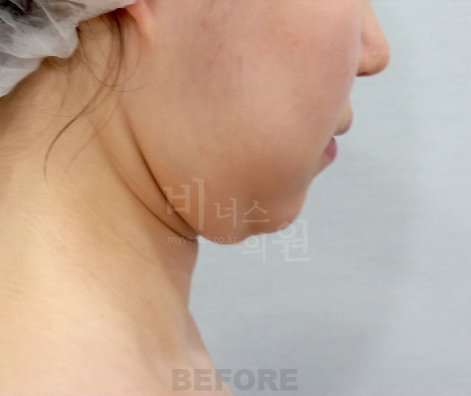 턱 목 부위 수술 전 측면(얼굴이 화면 오른쪽을 향함)