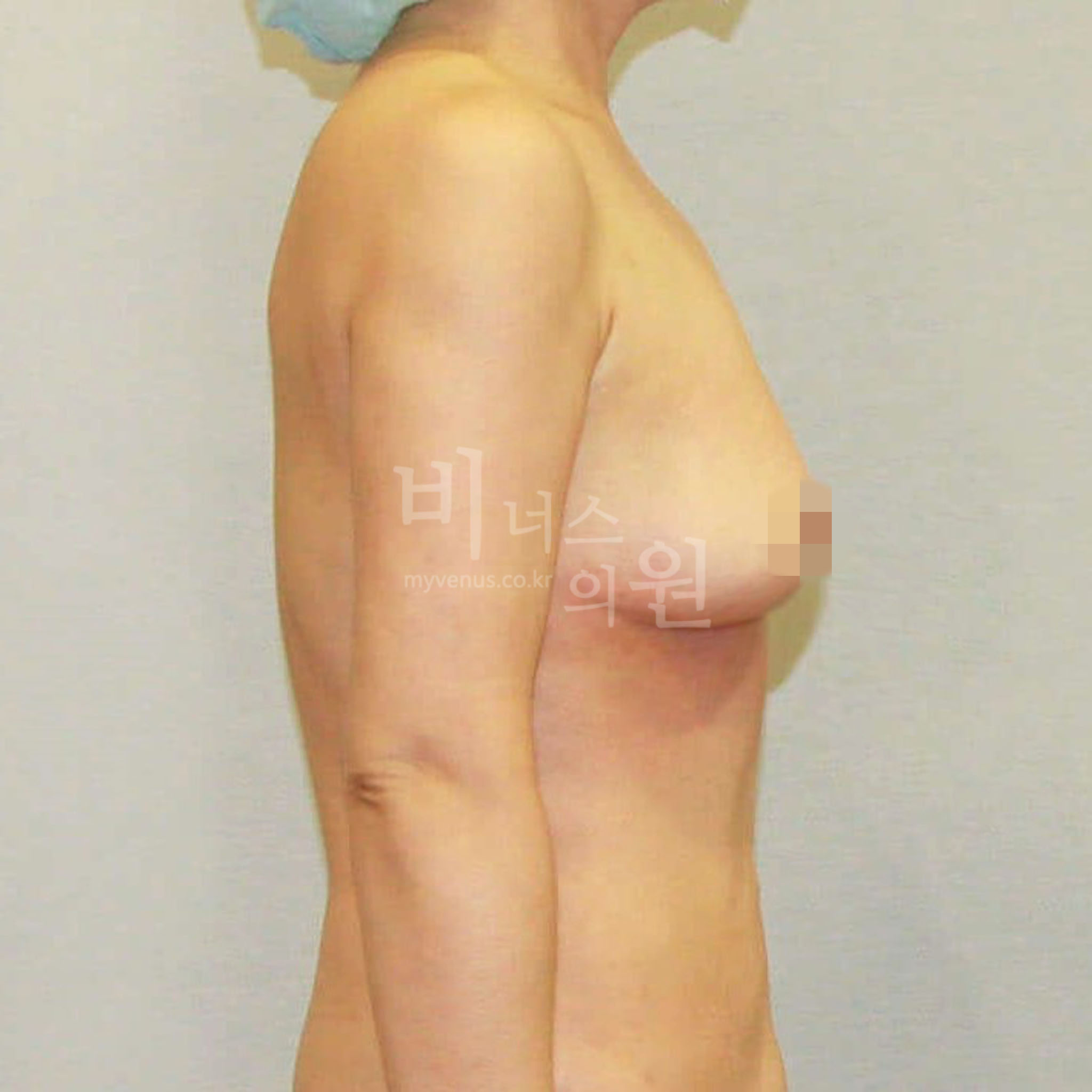 유방처짐 지방흡입 수술 후 측면