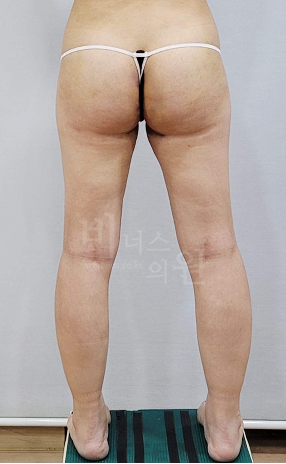 엉덩이 볼륨업 지방흡입·자가지방이식 수술 후 후면 · 발 벌림
