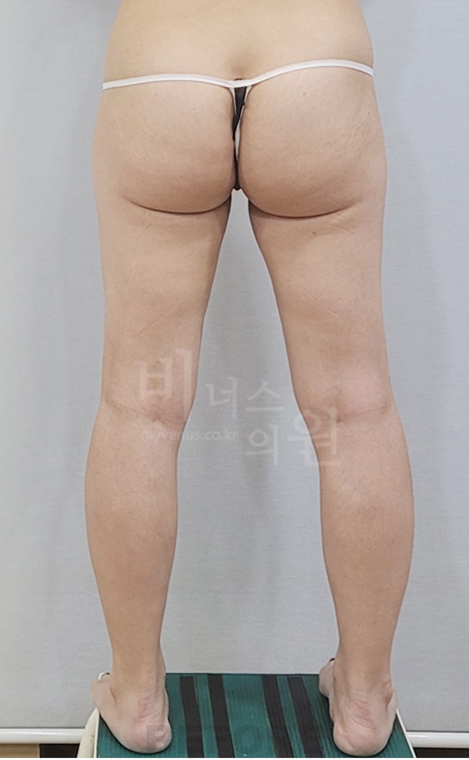 엉덩이 볼륨업 지방흡입·자가지방이식 수술 전 후면 · 발 벌림
