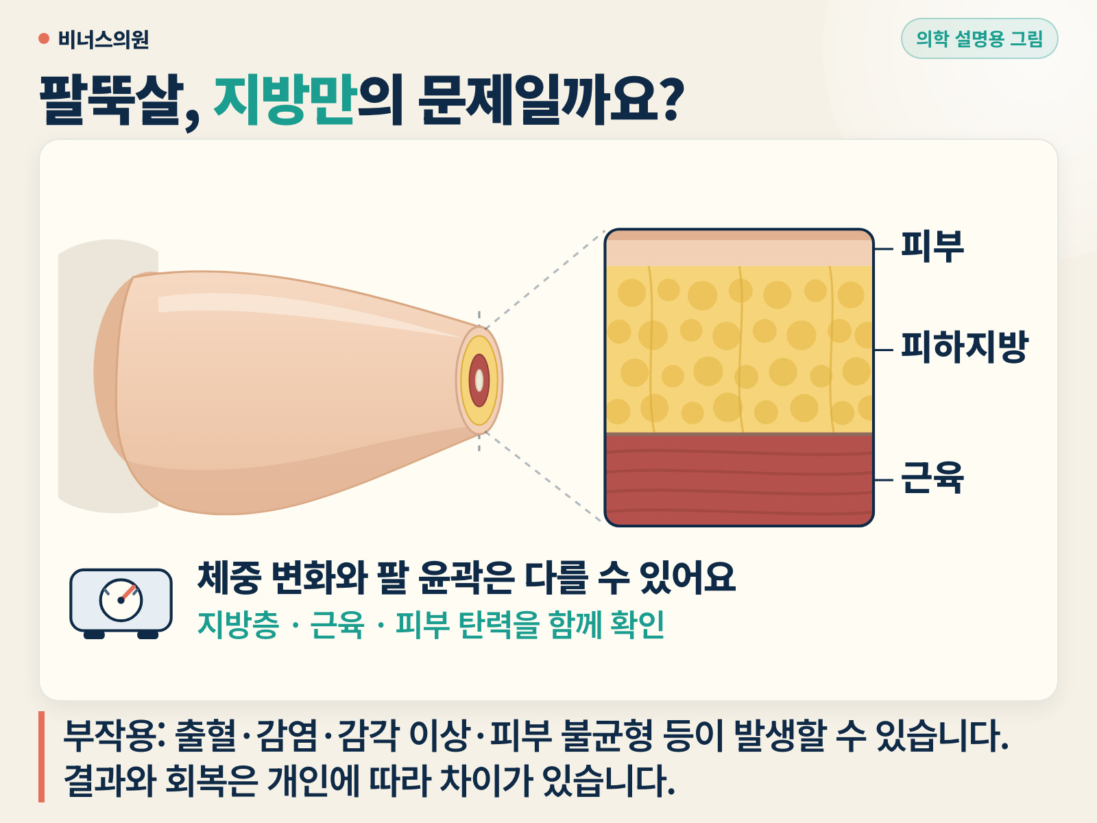 상완의 겉모습과 확대한 조직 단면을 나란히 보여주는 설명용 그림. 피부, 피하지방, 근육 층이 색으로 구분되어 있고 체중계 보조 그림이 함께 있습니다.