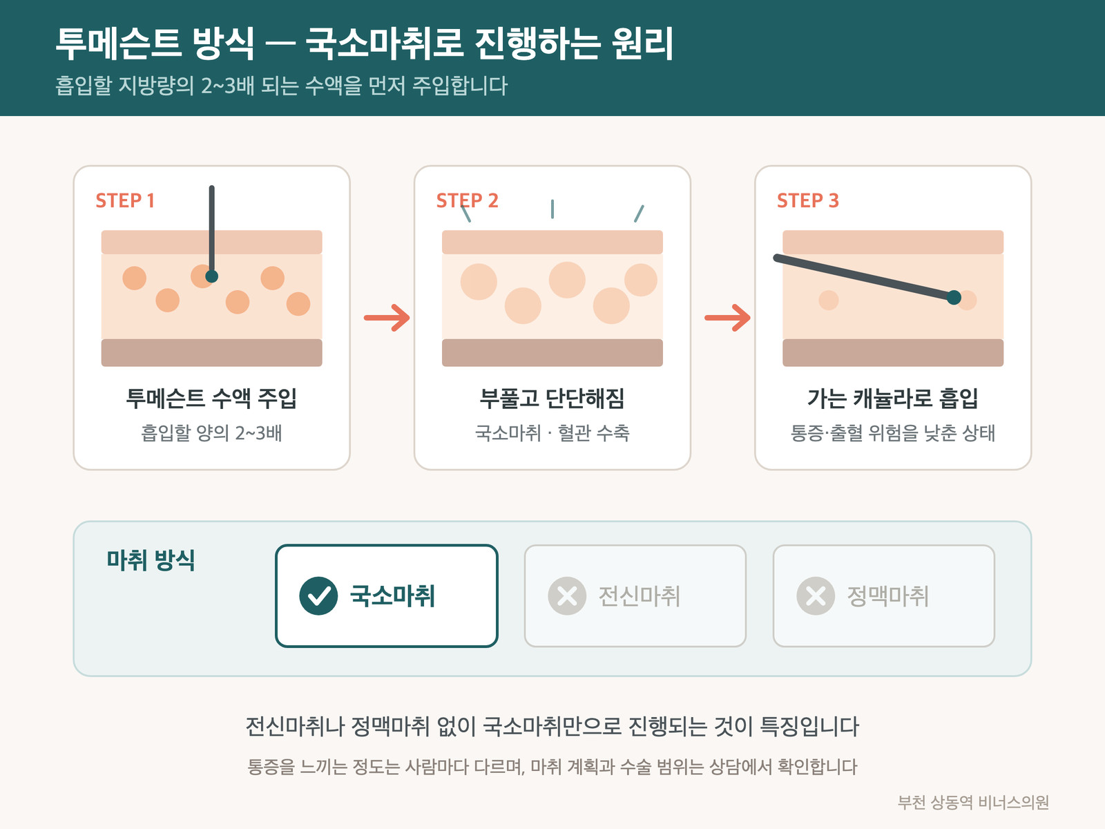 투메슨트 방식 국소마취 진행 원리 3단계 인포그래픽