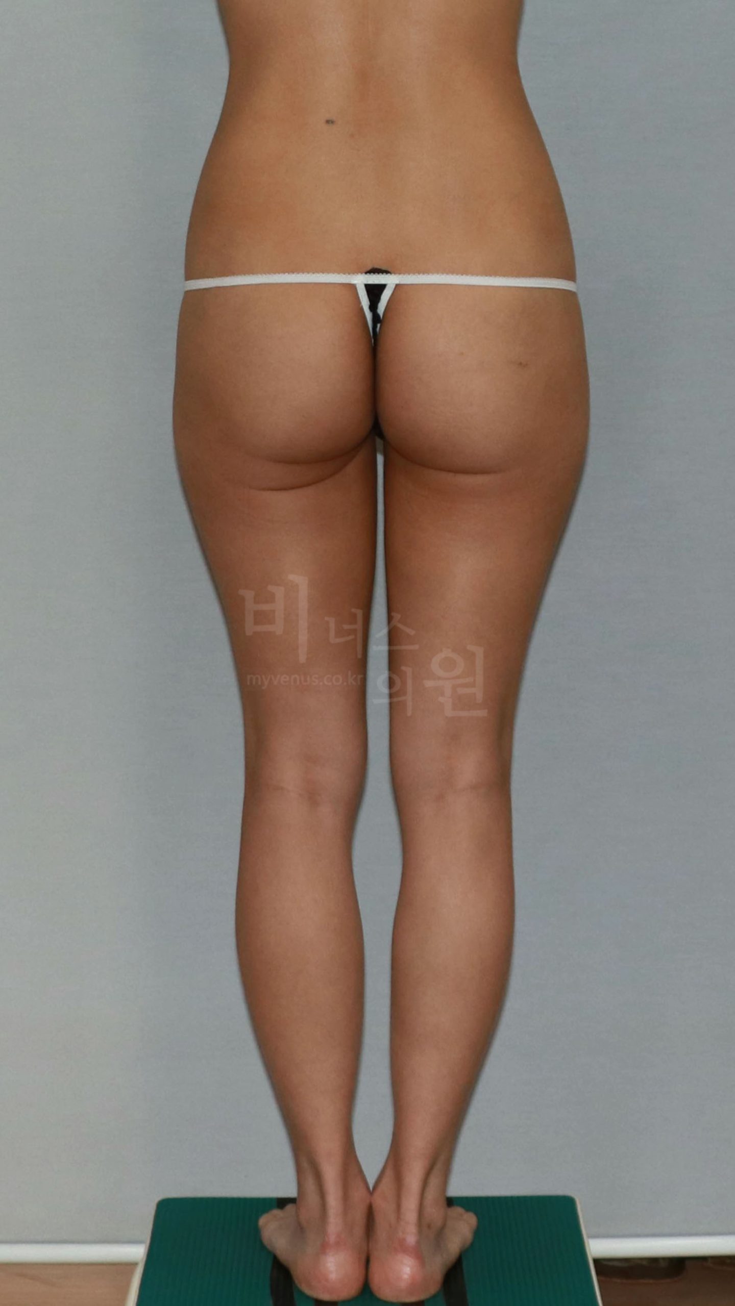 엉덩이축소 수술 전 후면 사진