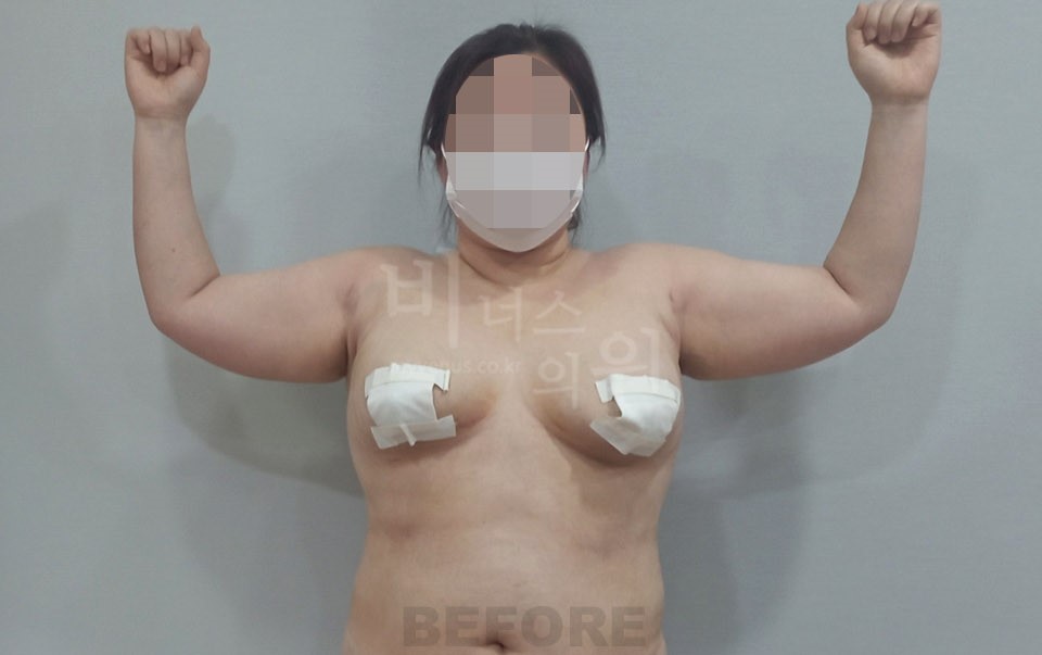 팔뚝지방흡입 수술 전 정면(팔 올림)