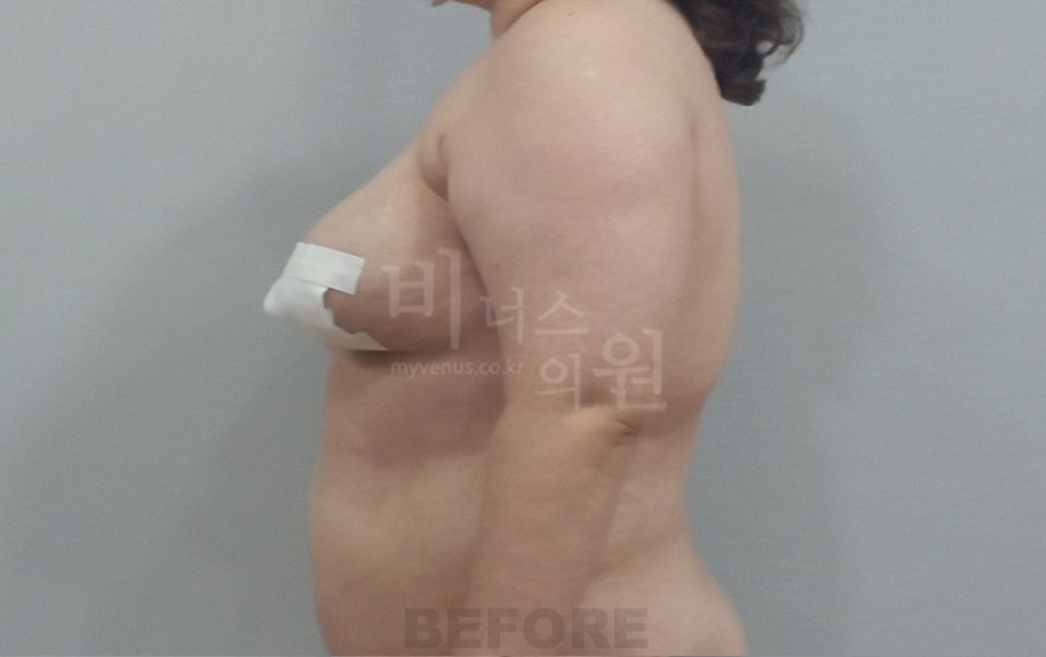 팔뚝지방흡입 수술 전 측면(팔 내림)