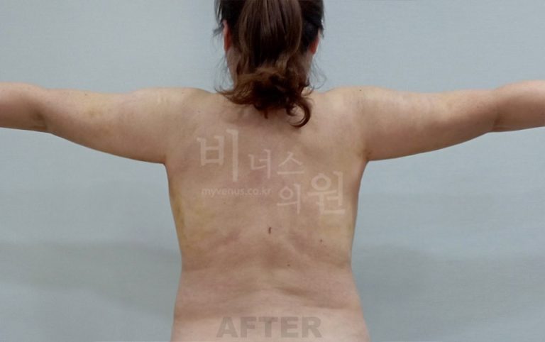 팔뚝지방흡입 비용, 무엇을 먼저 봐야 후회가 없을까 — 상담 전 선택 가이드