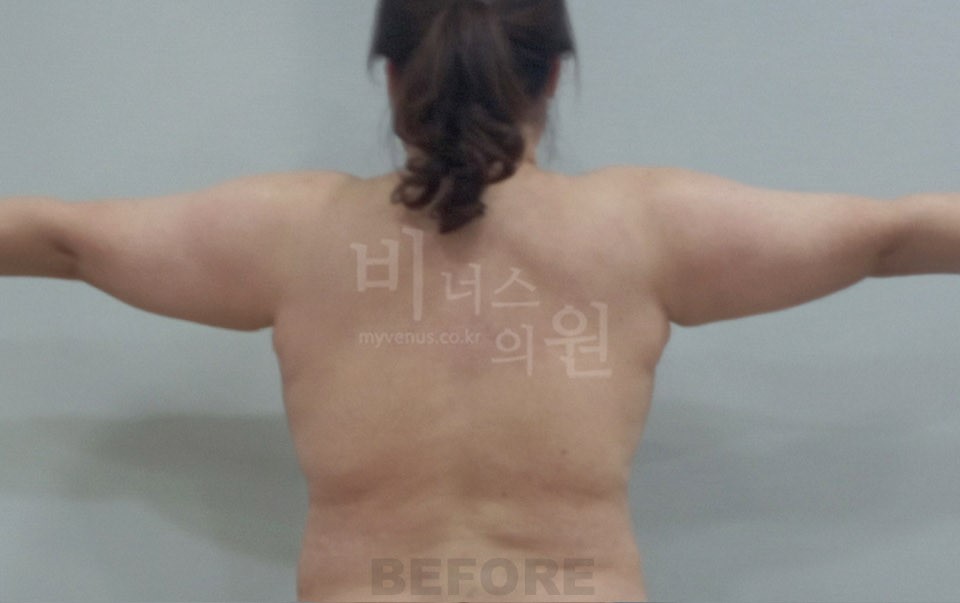 팔뚝지방흡입 수술 전 후면(팔 벌림)