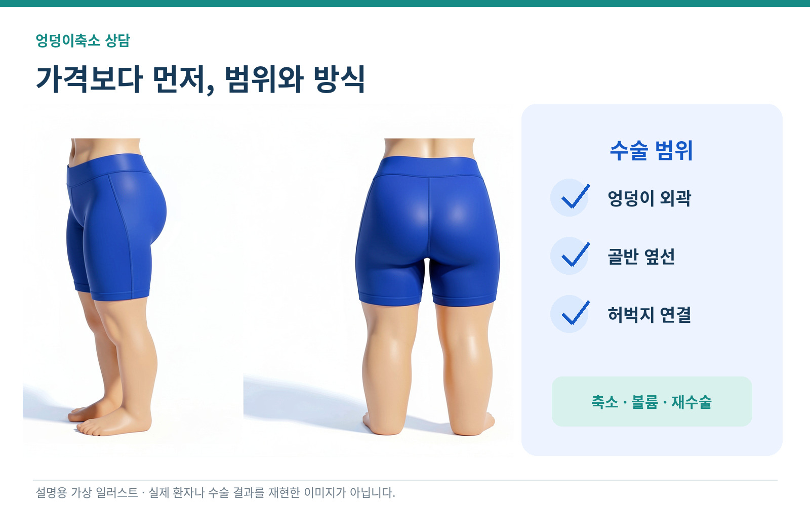 엉덩이축소 상담에서 가격보다 먼저 수술 범위와 방식을 확인하는 인포그래픽