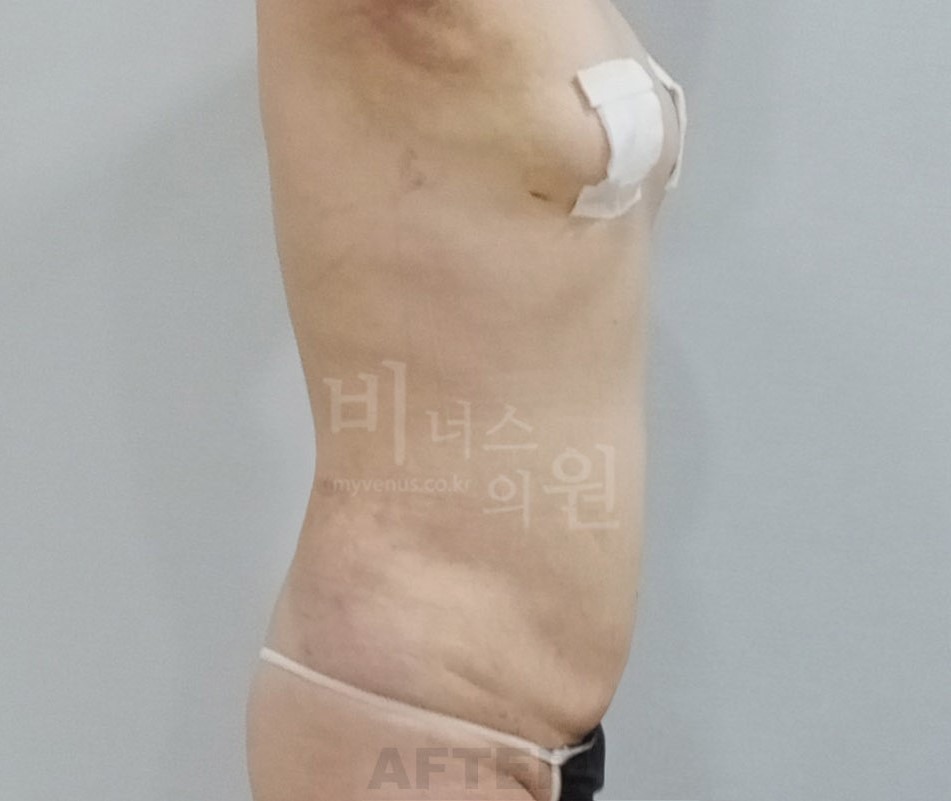 복부 지방흡입 수술 후 측면 사진