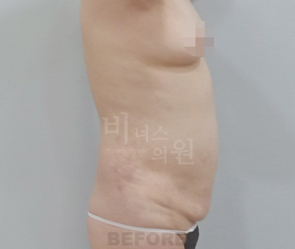 복부 지방흡입 수술 전 측면 사진