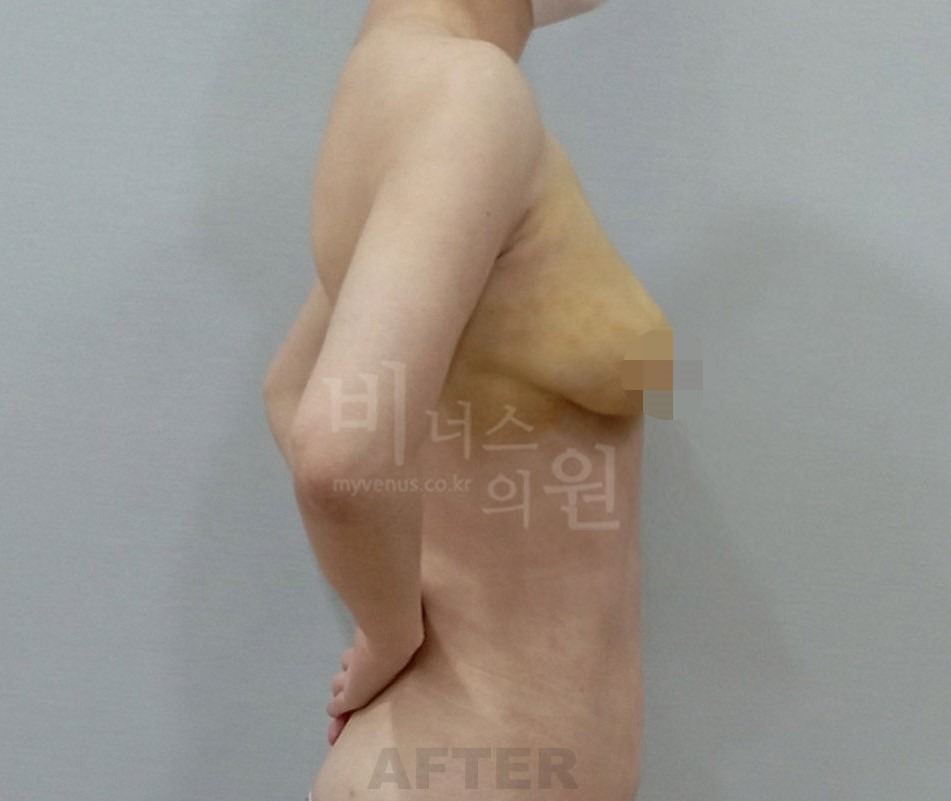 유방하수 가슴 지방흡입 수술 후 측면 사진
