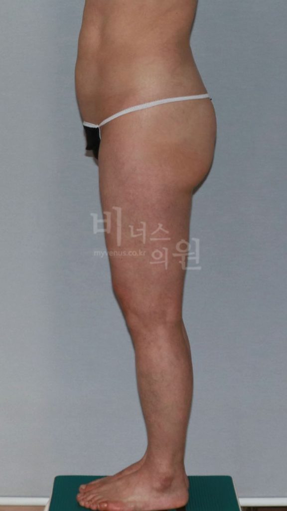 엉덩이 지방흡입 수술 전 우측면