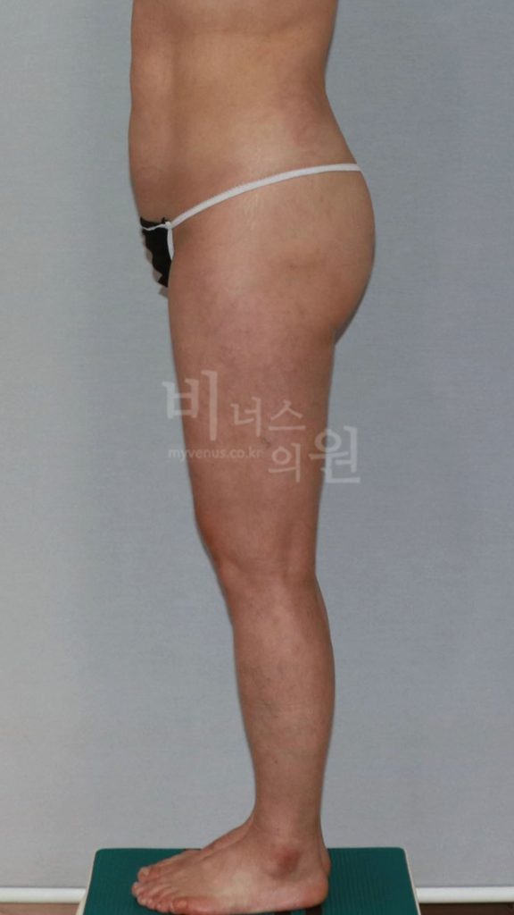 엉덩이 지방흡입 수술 후 우측면