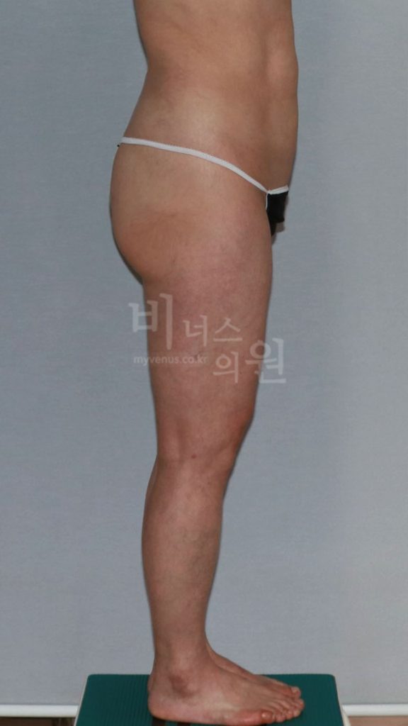엉덩이 지방흡입 수술 전 좌측면