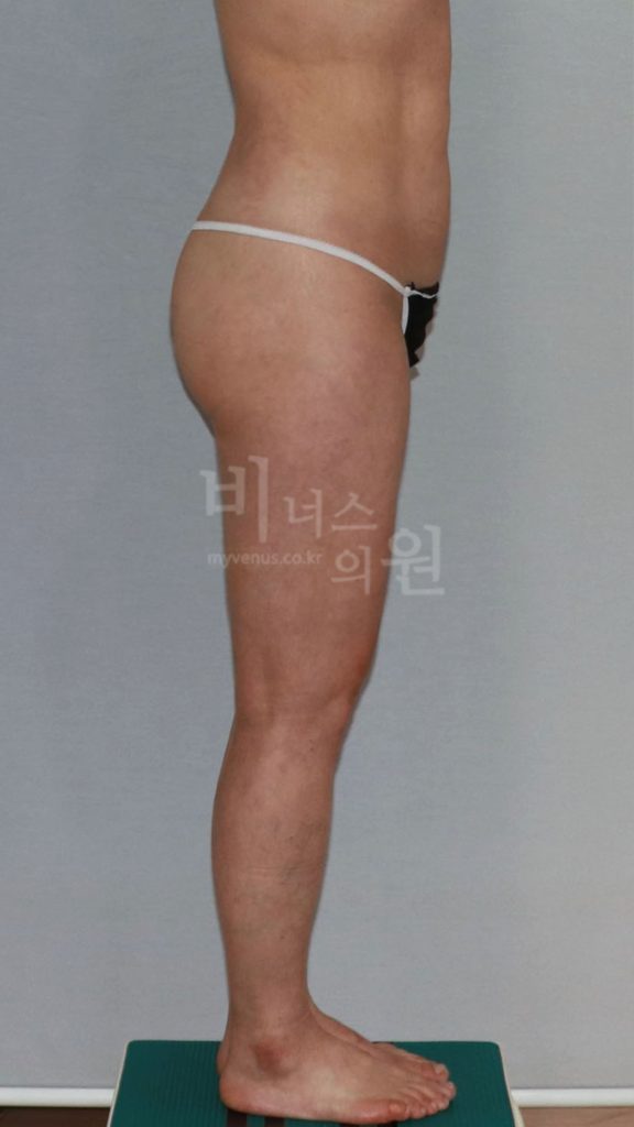 엉덩이 지방흡입 수술 후 좌측면