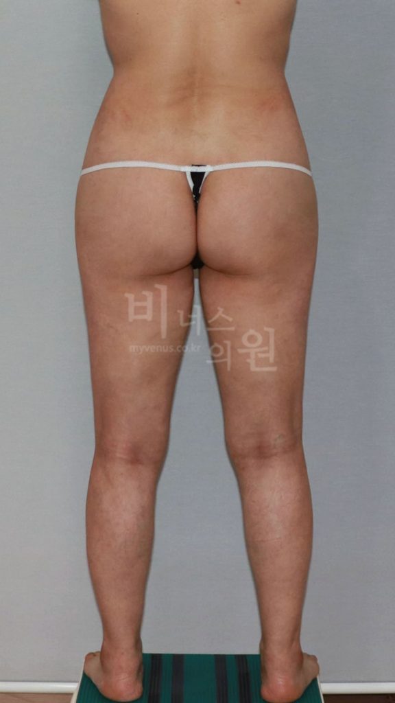 엉덩이 지방흡입 수술 후 후면