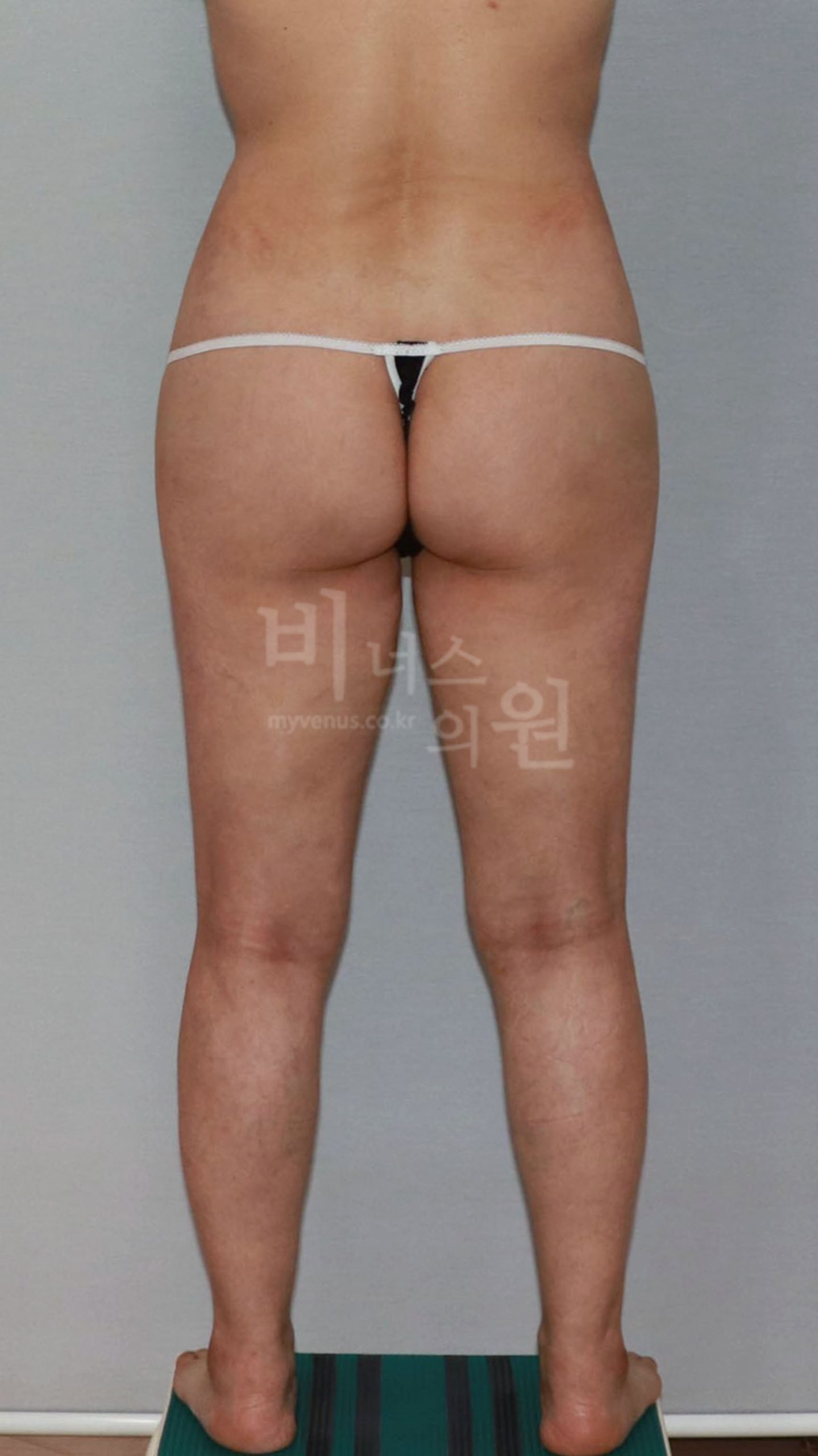 엉덩이 지방흡입 수술후 후면