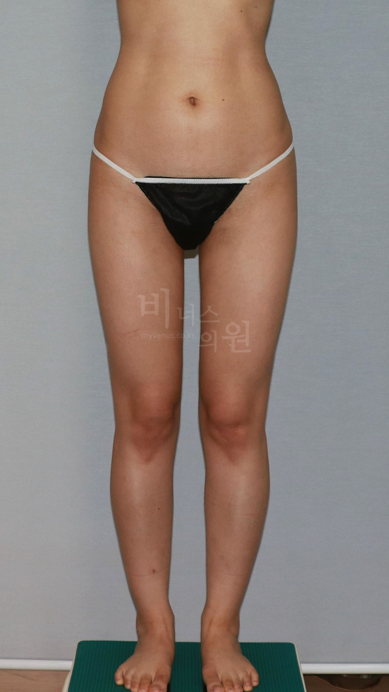 엉덩이축소 지방흡입 수술 후 정면