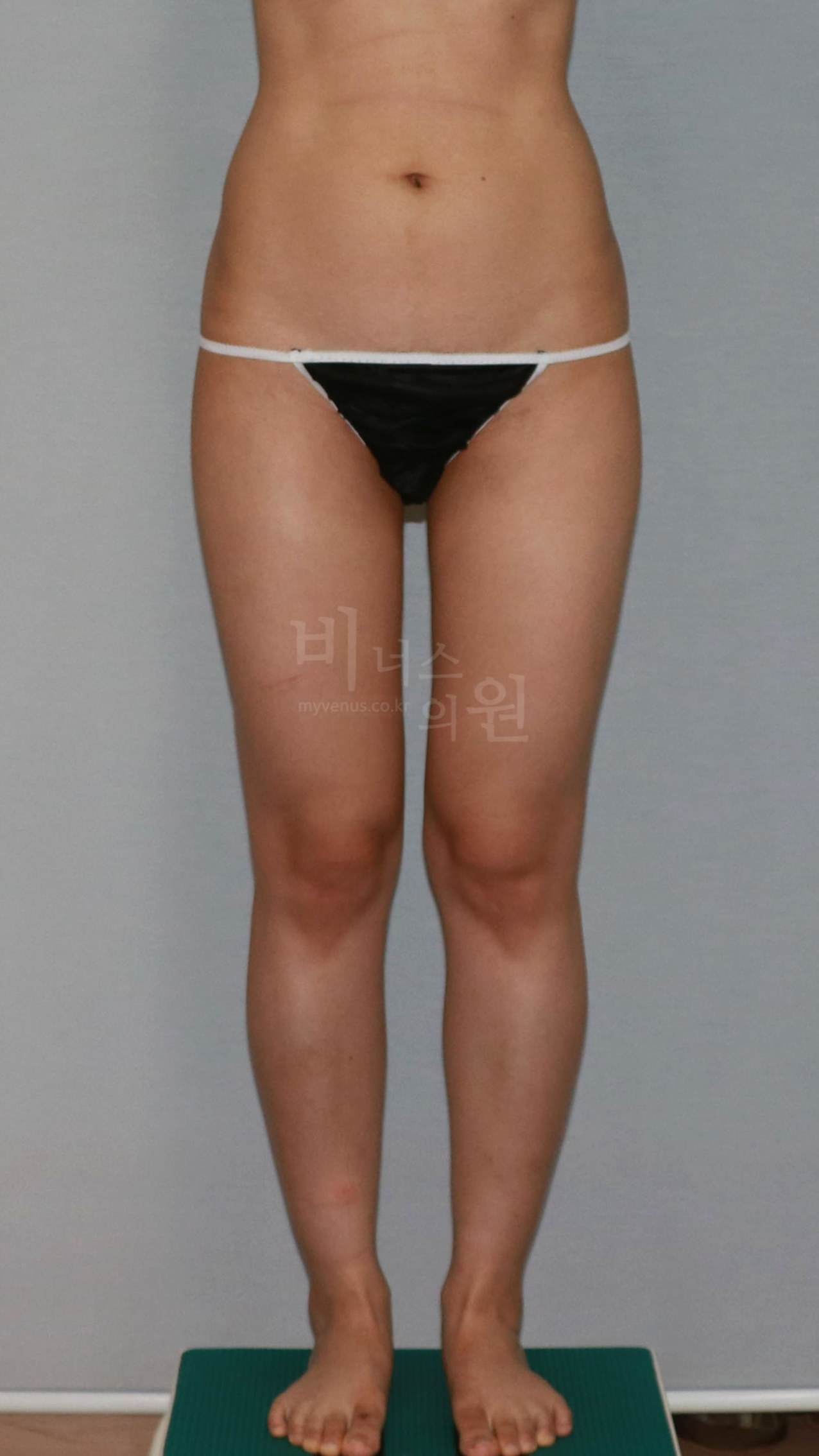 엉덩이축소 지방흡입 수술 전 정면