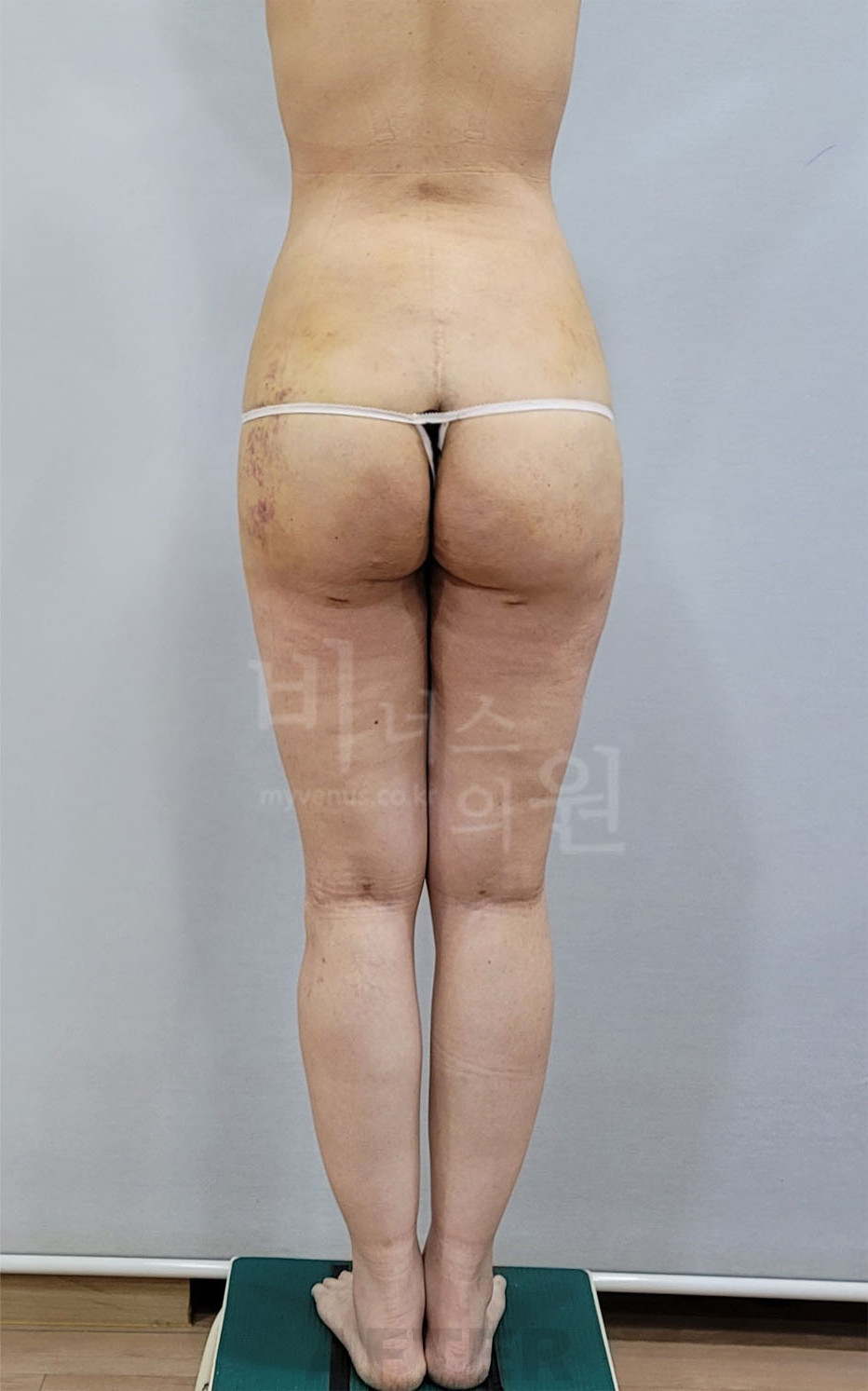 엉덩이축소 지방흡입 후면 뒤태 라인 수술 후
