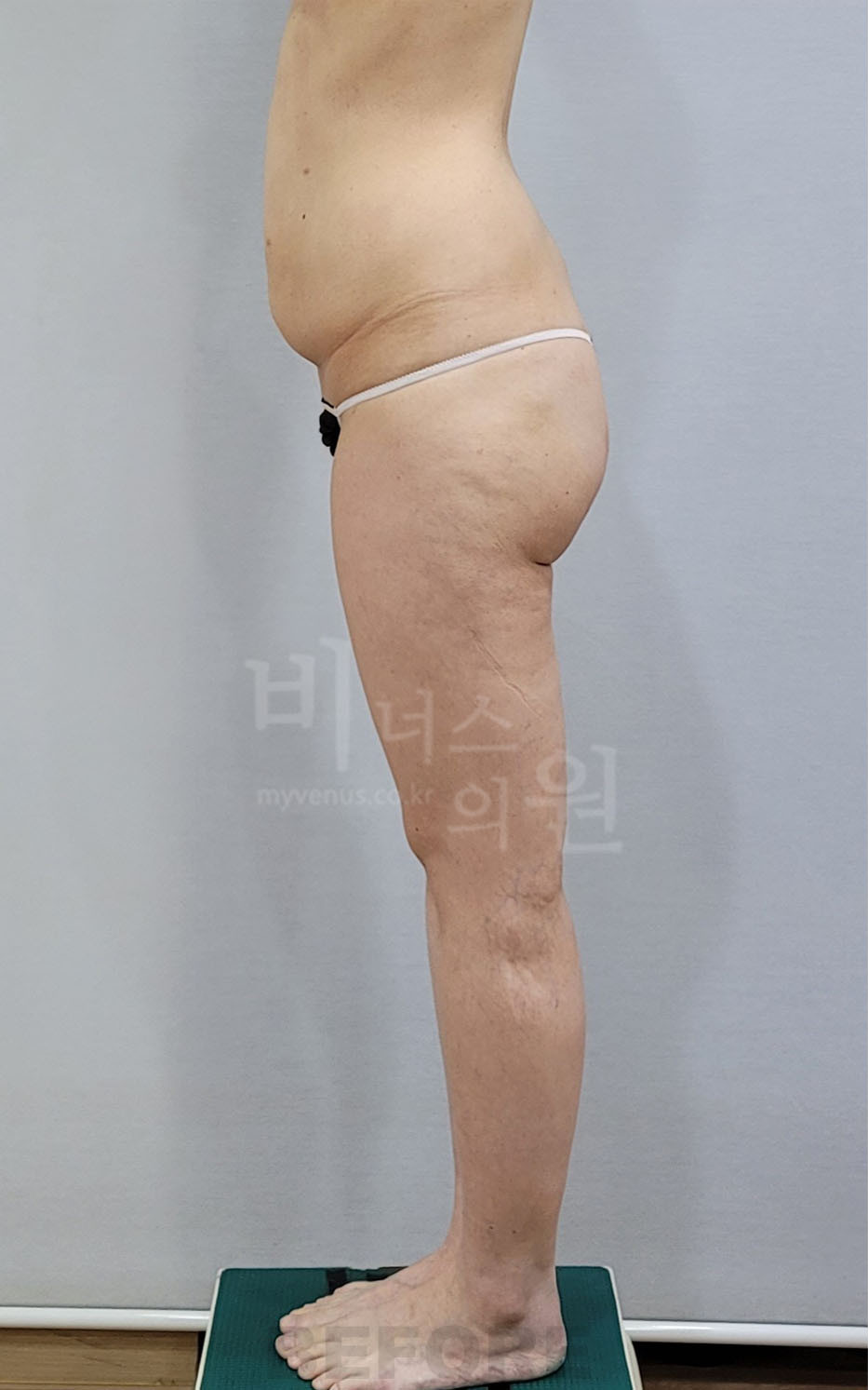 엉덩이축소 지방흡입 우측면 라인 수술 전