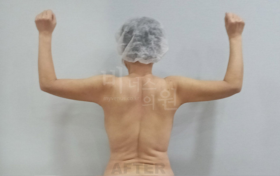 팔뚝지방흡입 후면 수술 후
