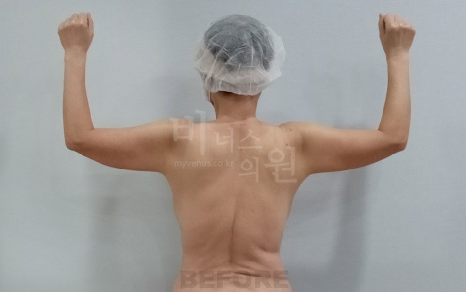 팔뚝지방흡입 후면 수술 전