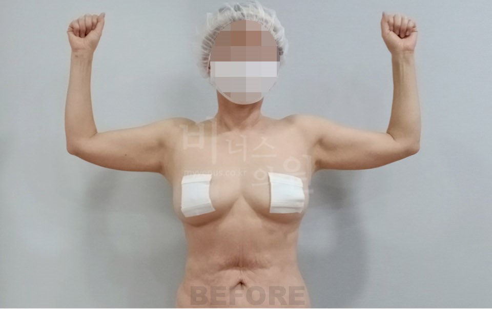 팔뚝지방흡입 정면 수술 전
