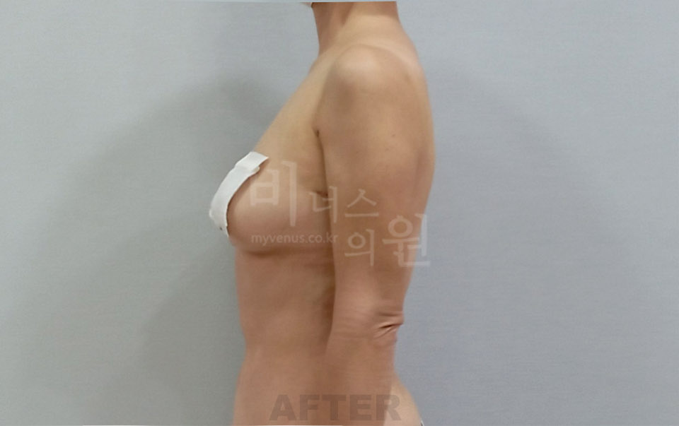 팔뚝지방흡입 측면 수술 후