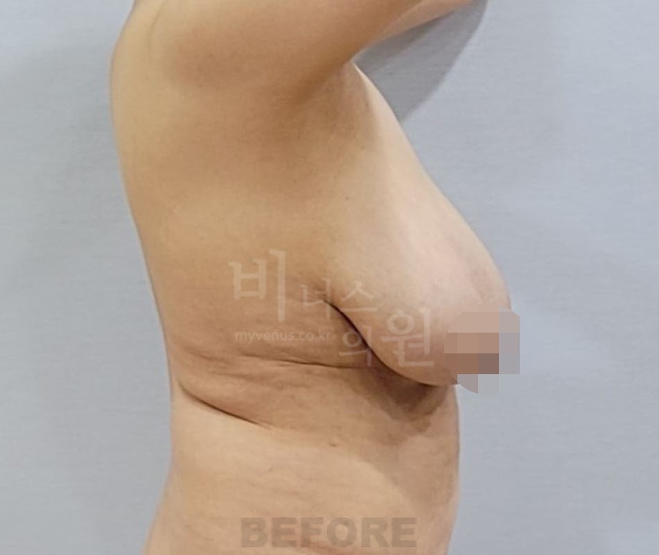 유방 지방흡입 수술 전 측면, 양팔 올림 자세