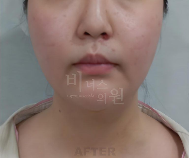 턱지방흡입, 이렇게 알고 계셨다면 오해입니다 — 자주 묻는 질문 6가지
