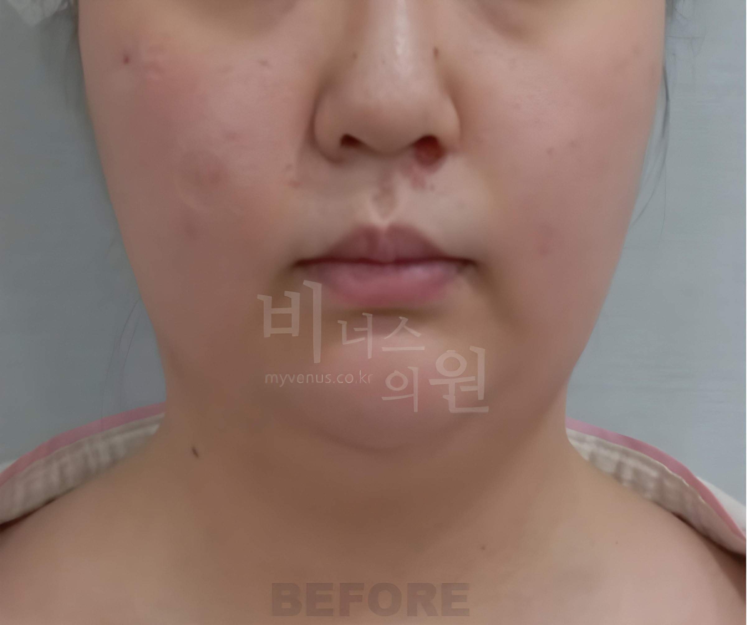 턱지방흡입 수술 전 정면