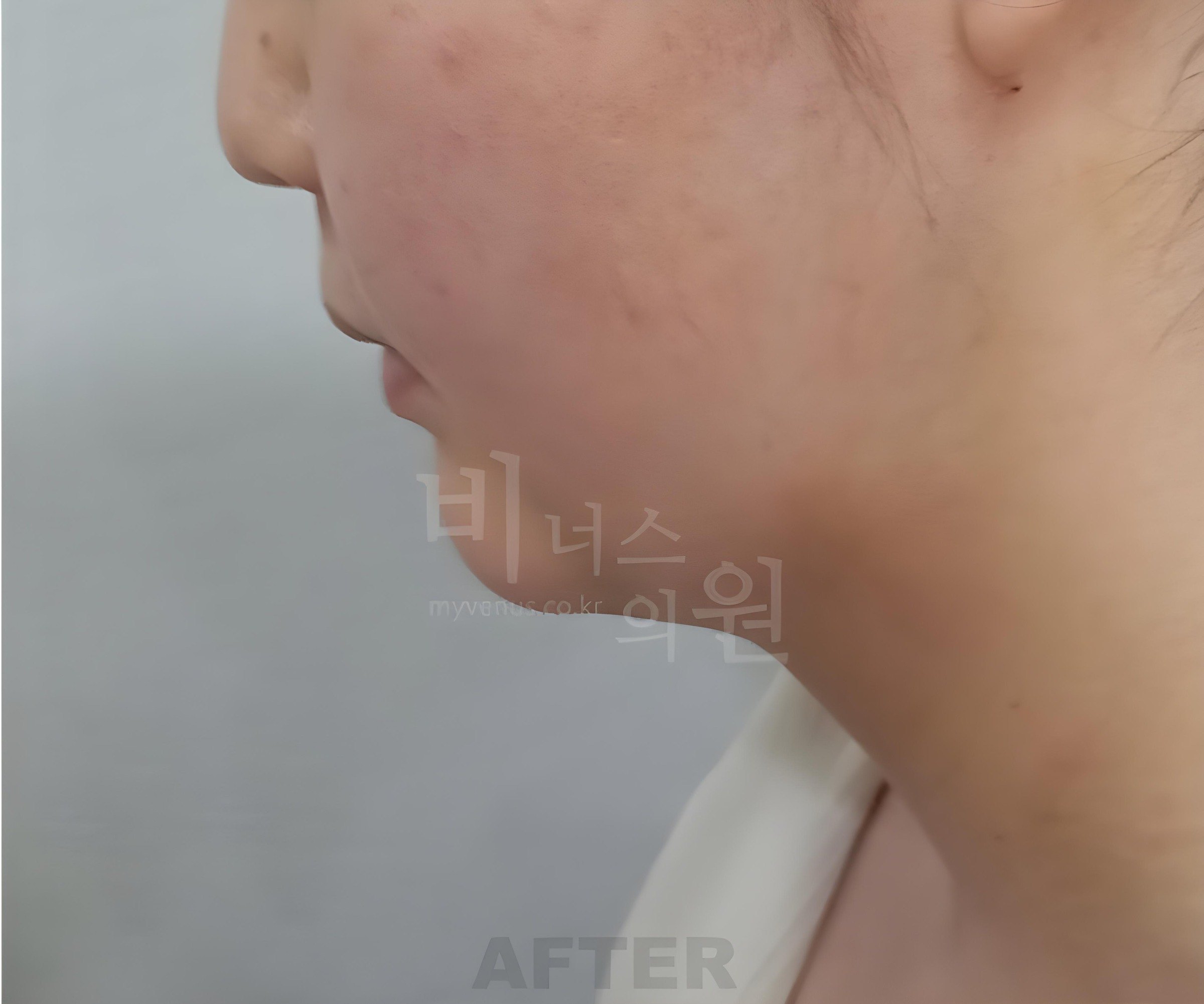 턱지방흡입 수술 후 측면