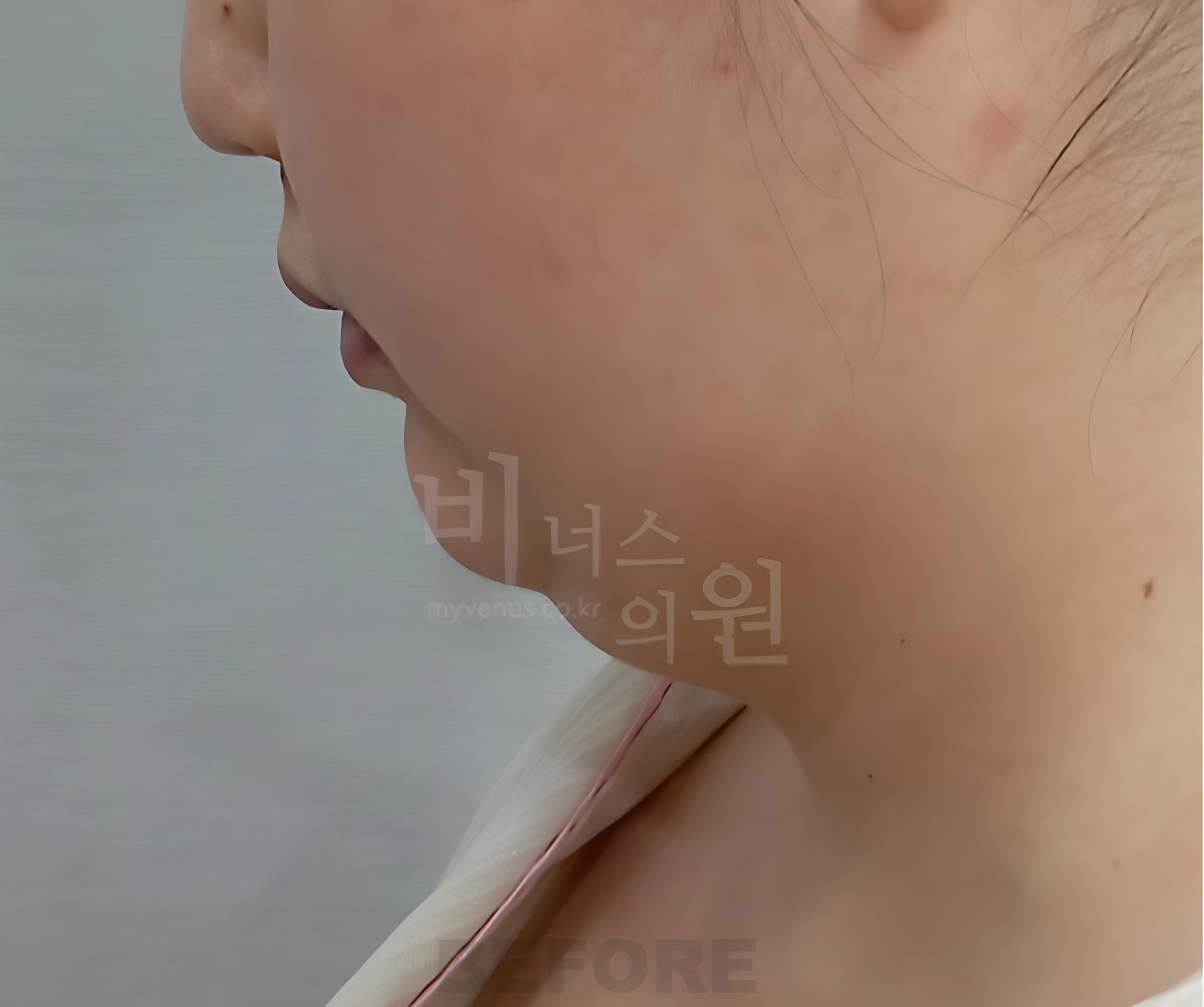 턱지방흡입 수술 전 측면