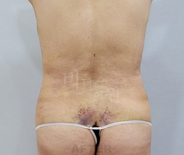 복부 지방흡입, 소문으로만 들었던 이야기 – Q&A로 하나씩 짚어봤습니다