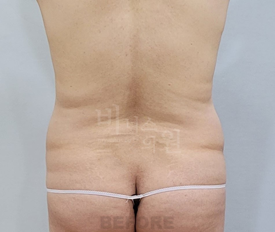 복부 지방흡입 수술 전 후면 허리 옆구리 라인