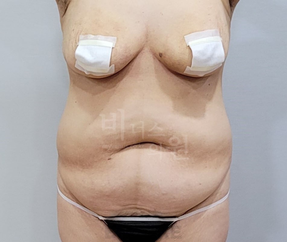 복부 지방흡입 수술 전 정면 복부 라인