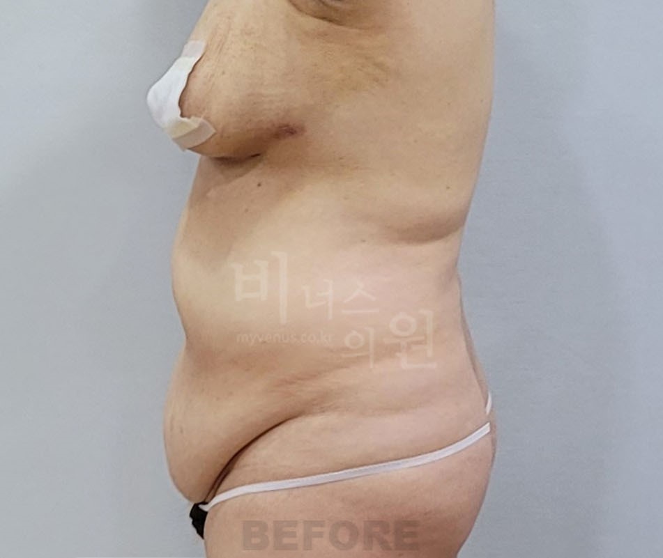복부 지방흡입 수술 전 좌측면 복부 두께