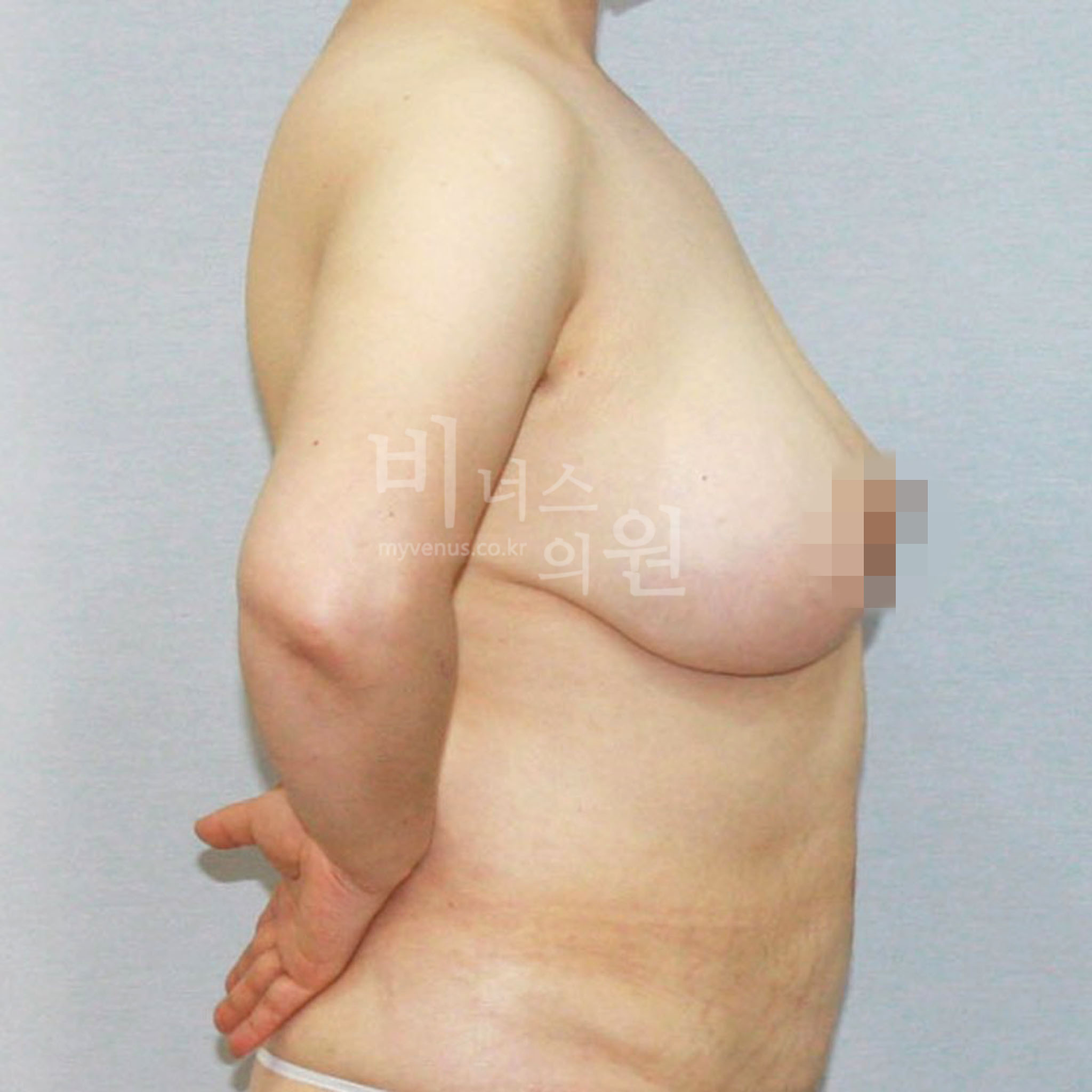유방 지방흡입 수술 전 측면