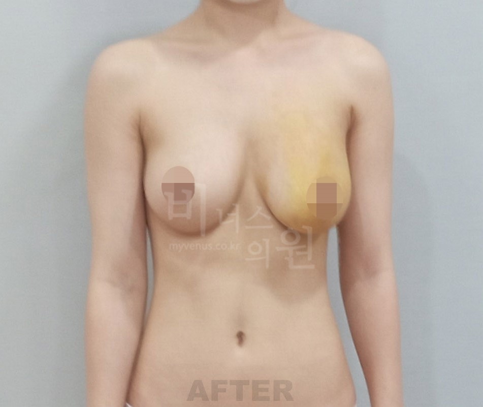 유방 지방흡입 수술 후 정면(팔을 내린 자세)
