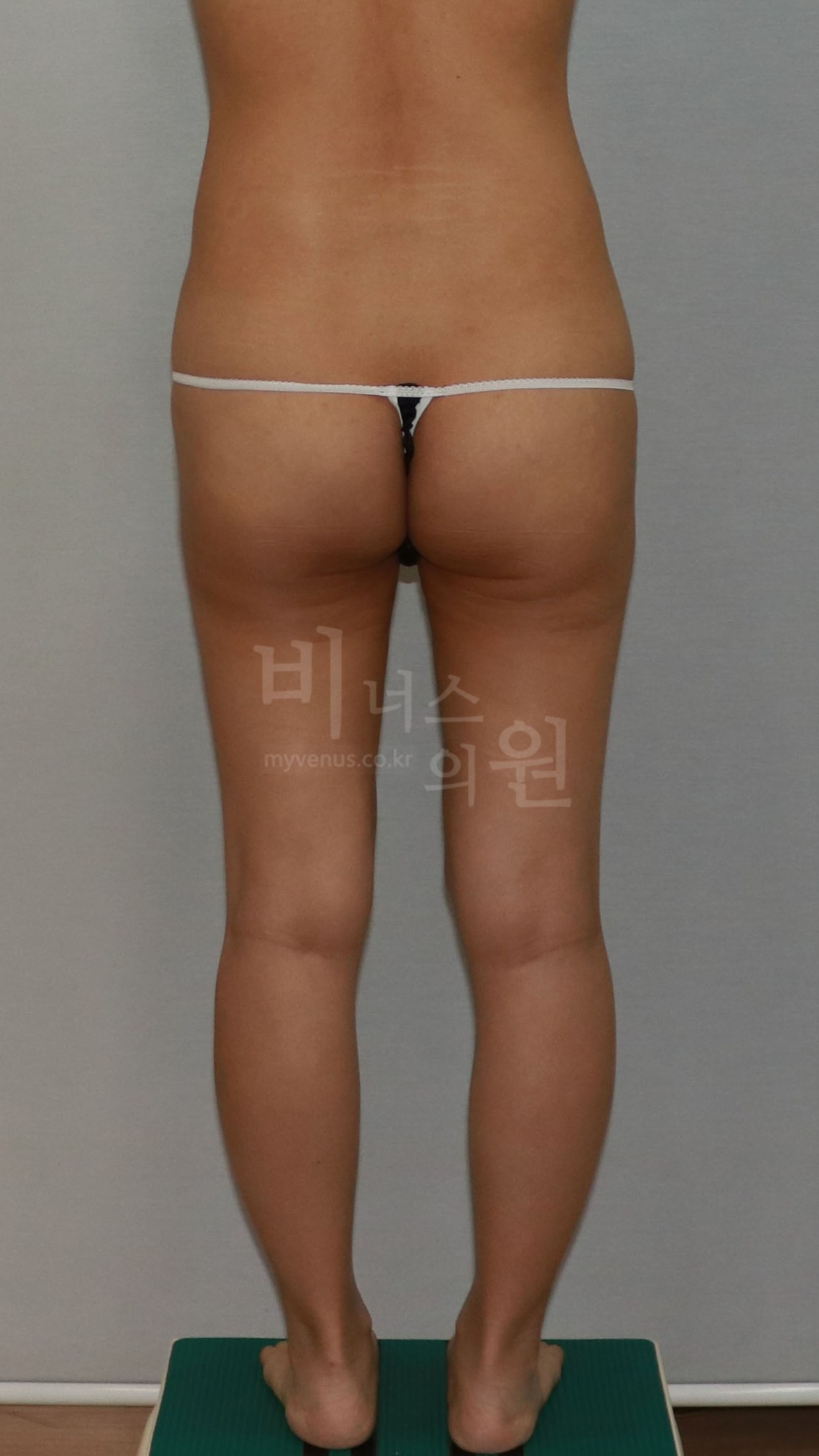 엉덩이축소 지방흡입 수술 전 후면 ①