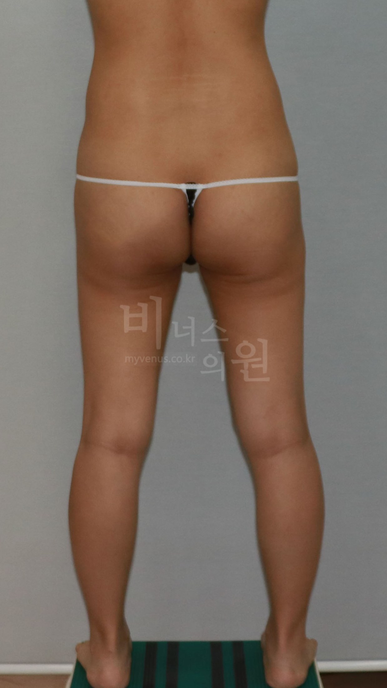 엉덩이축소 지방흡입 수술 전 후면 ②